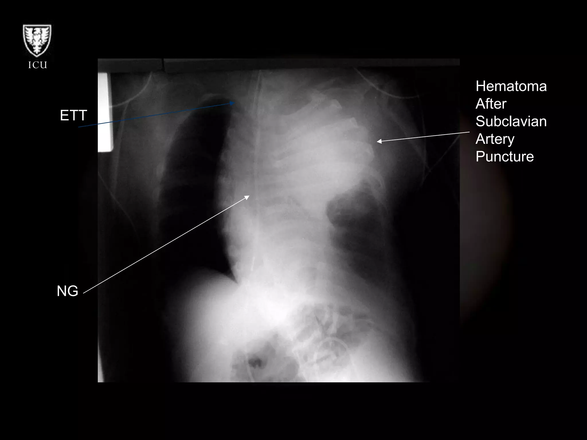 Hematoma After Subclavian Artery Puncture NG ETT 