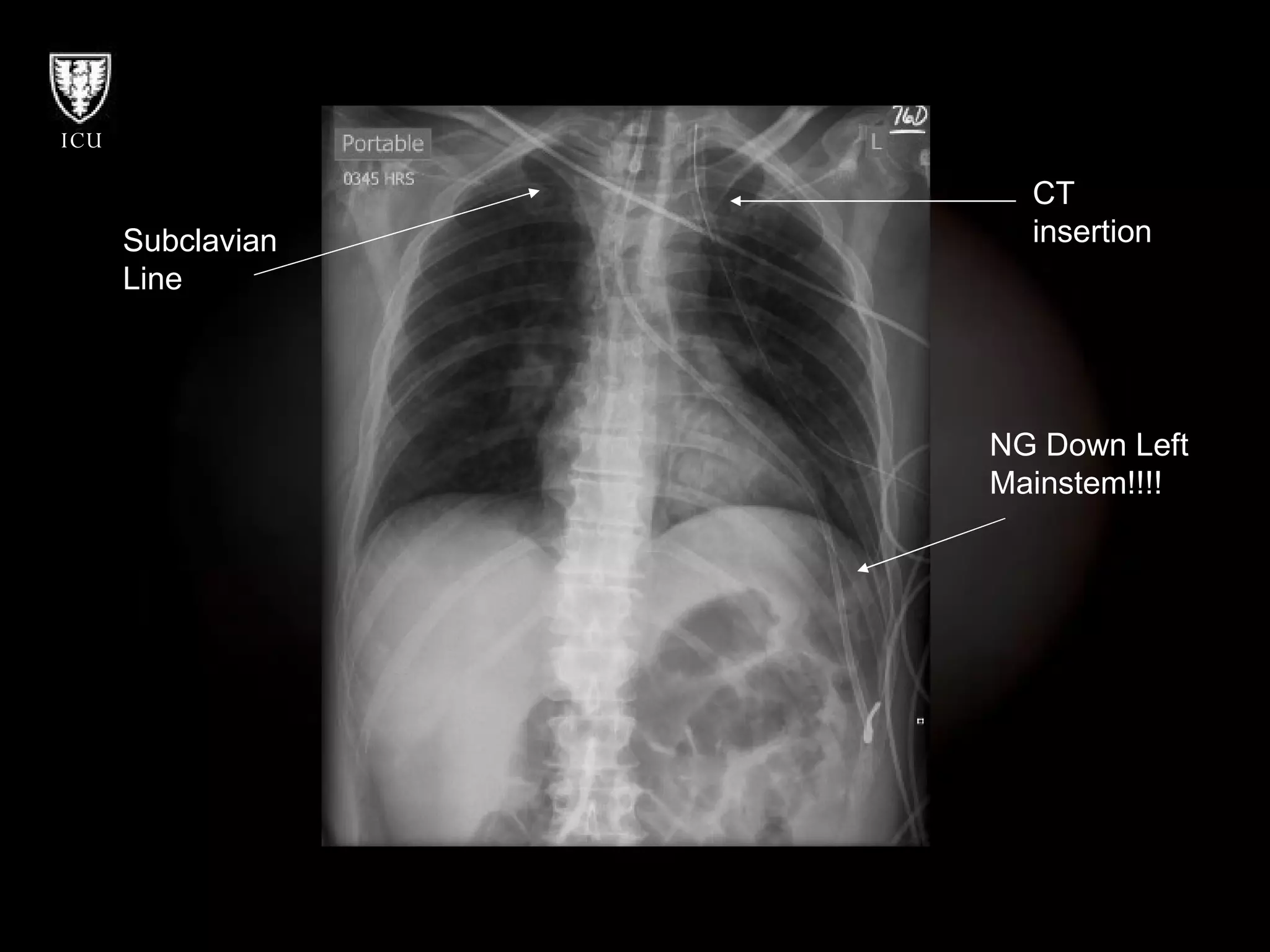 CT insertion Subclavian  Line NG Down Left Mainstem!!!! 