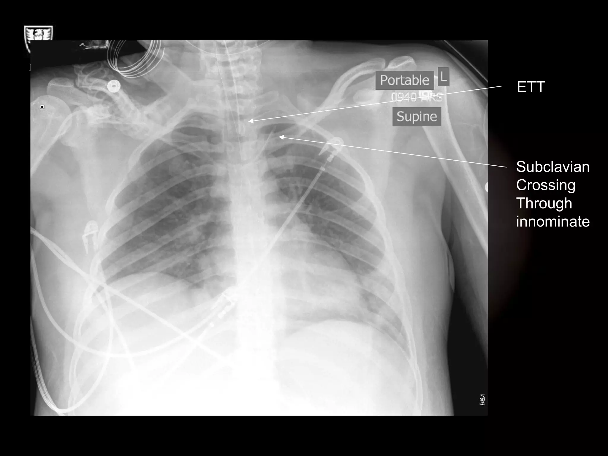 ETT Subclavian Crossing Through innominate 
