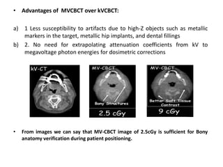 • Advantages of MVCBCT over kVCBCT:
a) 1 Less susceptibility to artifacts due to high-Z objects such as metallic
markers in the target, metallic hip implants, and dental fillings
b) 2. No need for extrapolating attenuation coefficients from kV to
megavoltage photon energies for dosimetric corrections
• From images we can say that MV-CBCT image of 2.5cGy is sufficient for Bony
anatomy verification during patient positioning.
 