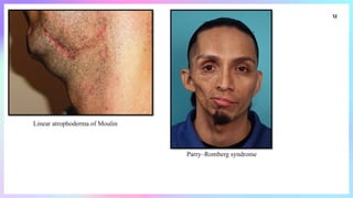 Linear_Lesions_In_Dermatology [1].pptxhhh | PPTX