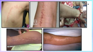 Linear_Lesions_In_Dermatology [1].pptxhhh | PPTX