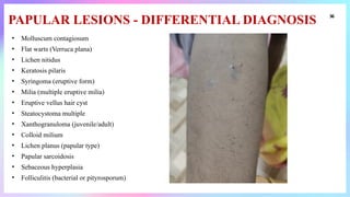 Linear_Lesions_In_Dermatology [1].pptxhhh | PPTX