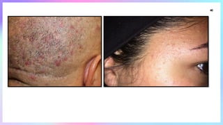 Linear_Lesions_In_Dermatology [1].pptxhhh | PPTX