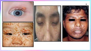 Linear_Lesions_In_Dermatology [1].pptxhhh | PPTX