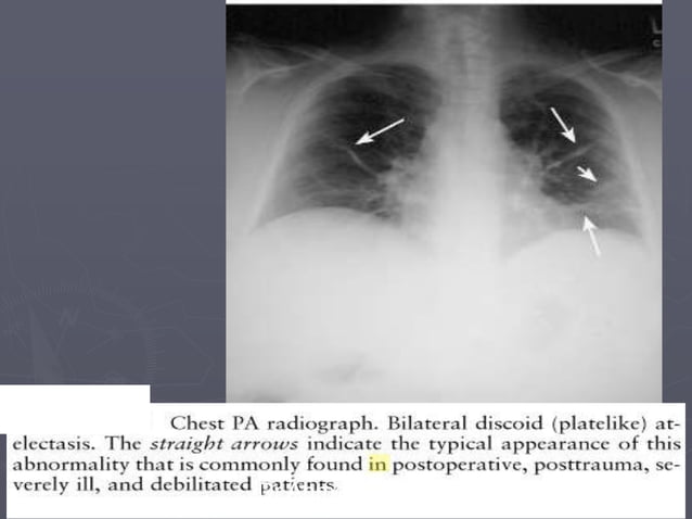 Linear lung density x ray Dr Ahmed Esawy | PDF