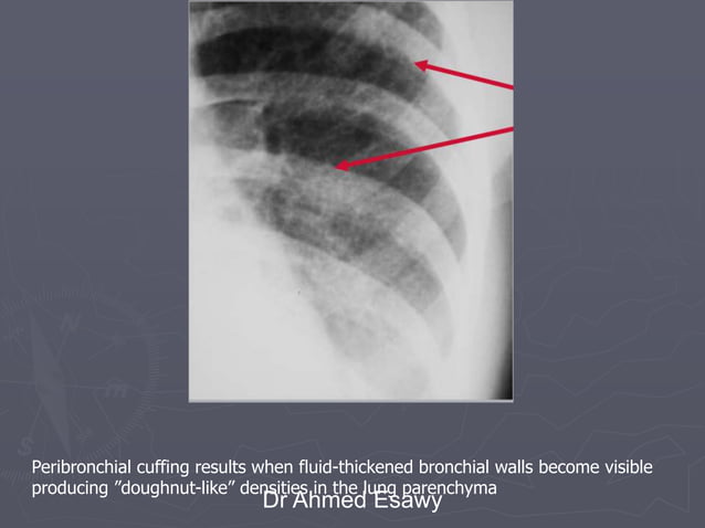 Linear lung density x ray Dr Ahmed Esawy | PDF