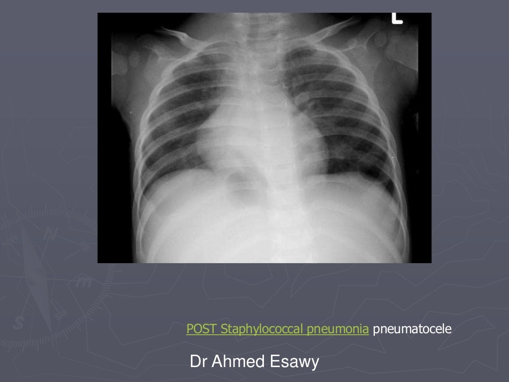 Linear lung density x ray Dr Ahmed Esawy