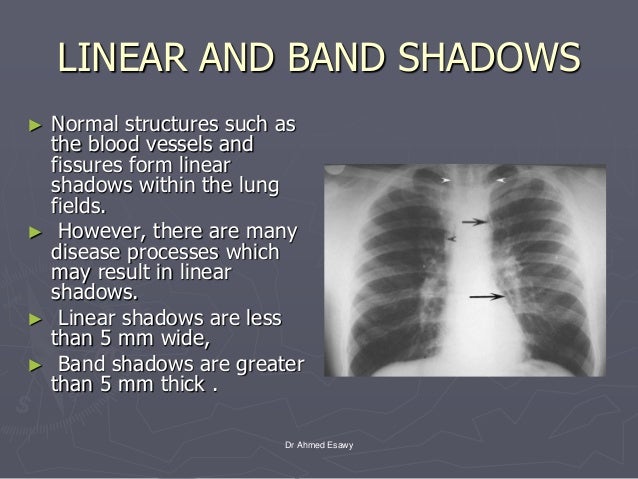 Linear lung density x ray Dr Ahmed Esawy