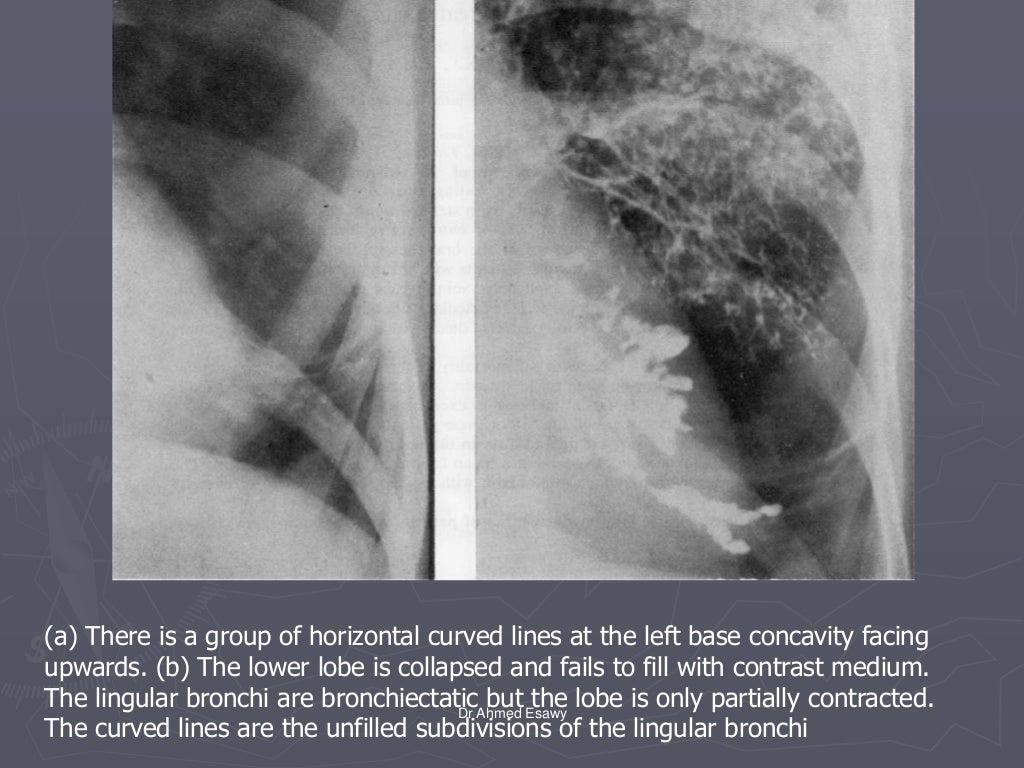 Linear lung density x ray Dr Ahmed Esawy