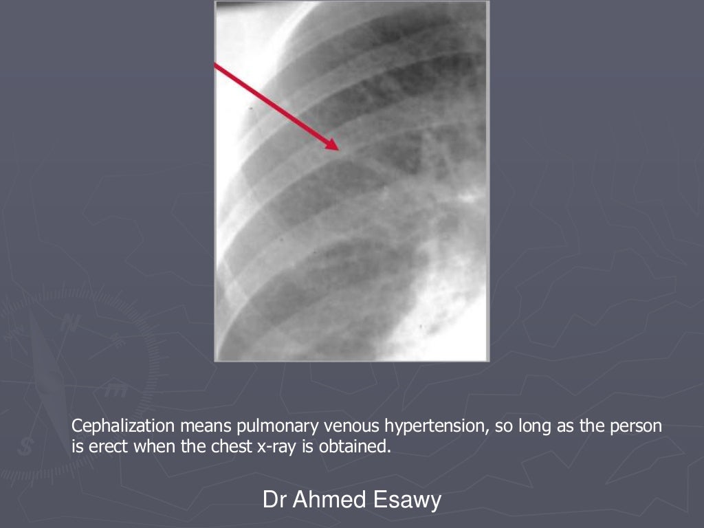 Linear lung density x ray Dr Ahmed Esawy