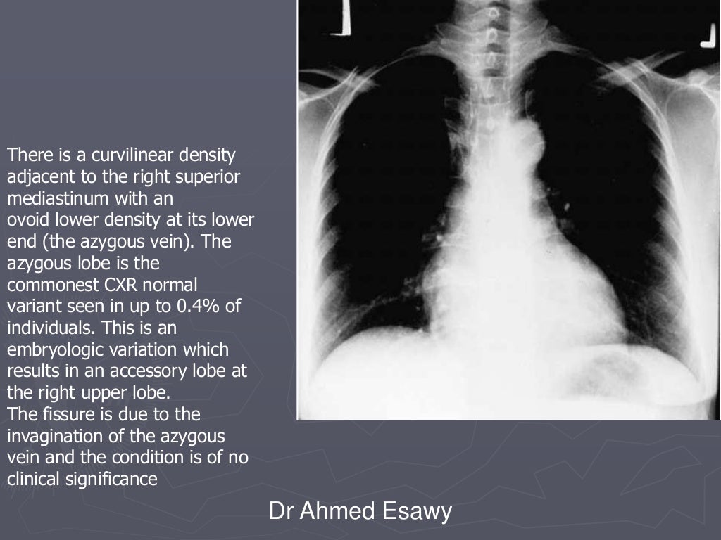 Linear lung density x ray Dr Ahmed Esawy