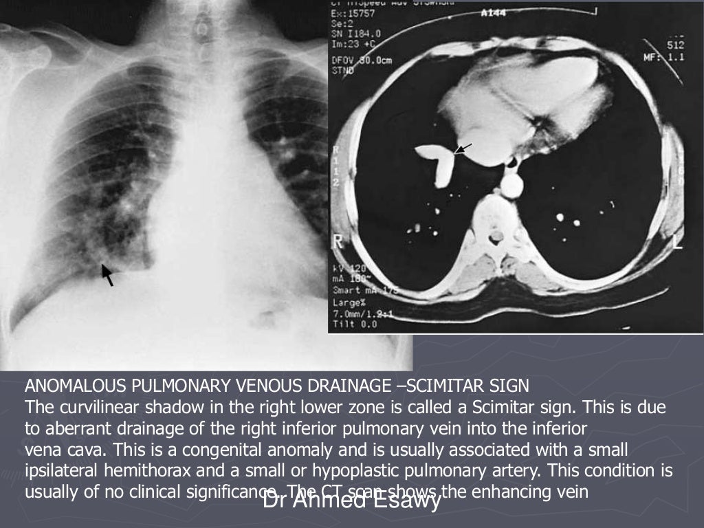 Linear lung density x ray Dr Ahmed Esawy