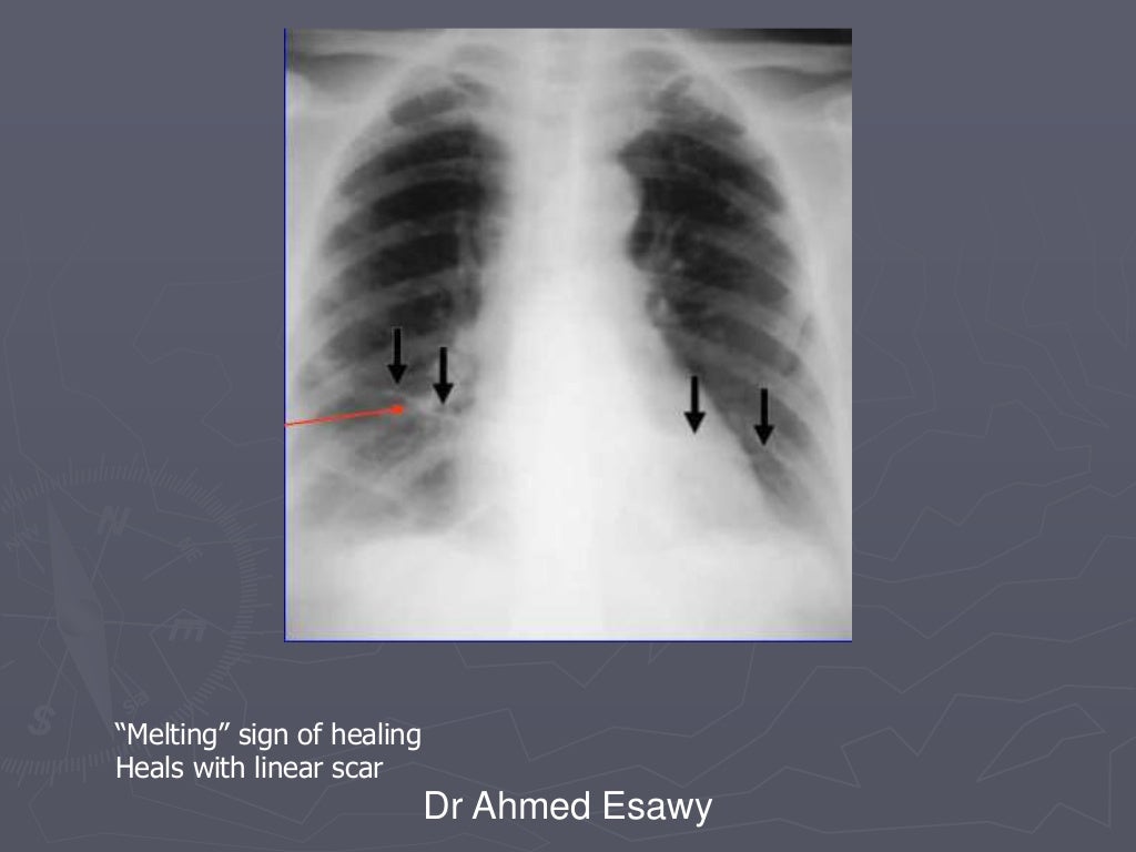 Linear lung density x ray Dr Ahmed Esawy