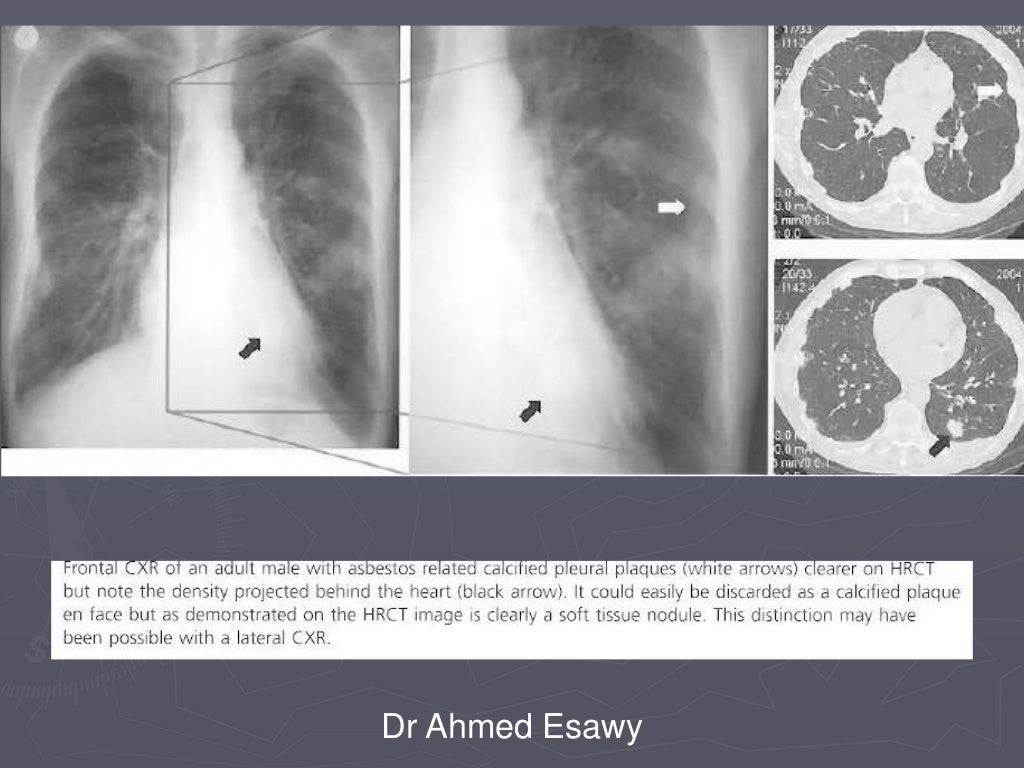 Linear lung density x ray Dr Ahmed Esawy