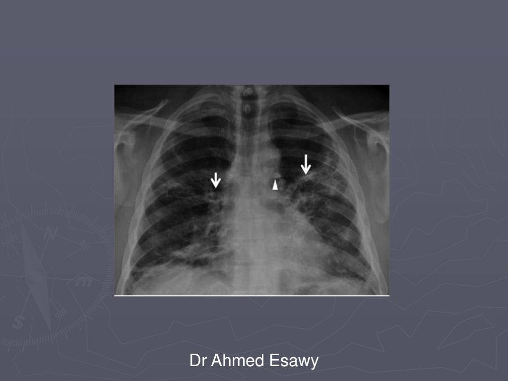 Linear lung density x ray Dr Ahmed Esawy