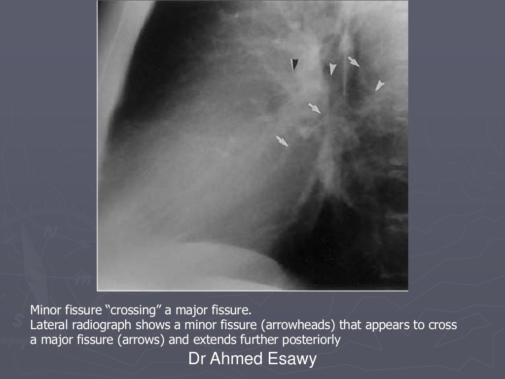 Linear lung density x ray Dr Ahmed Esawy