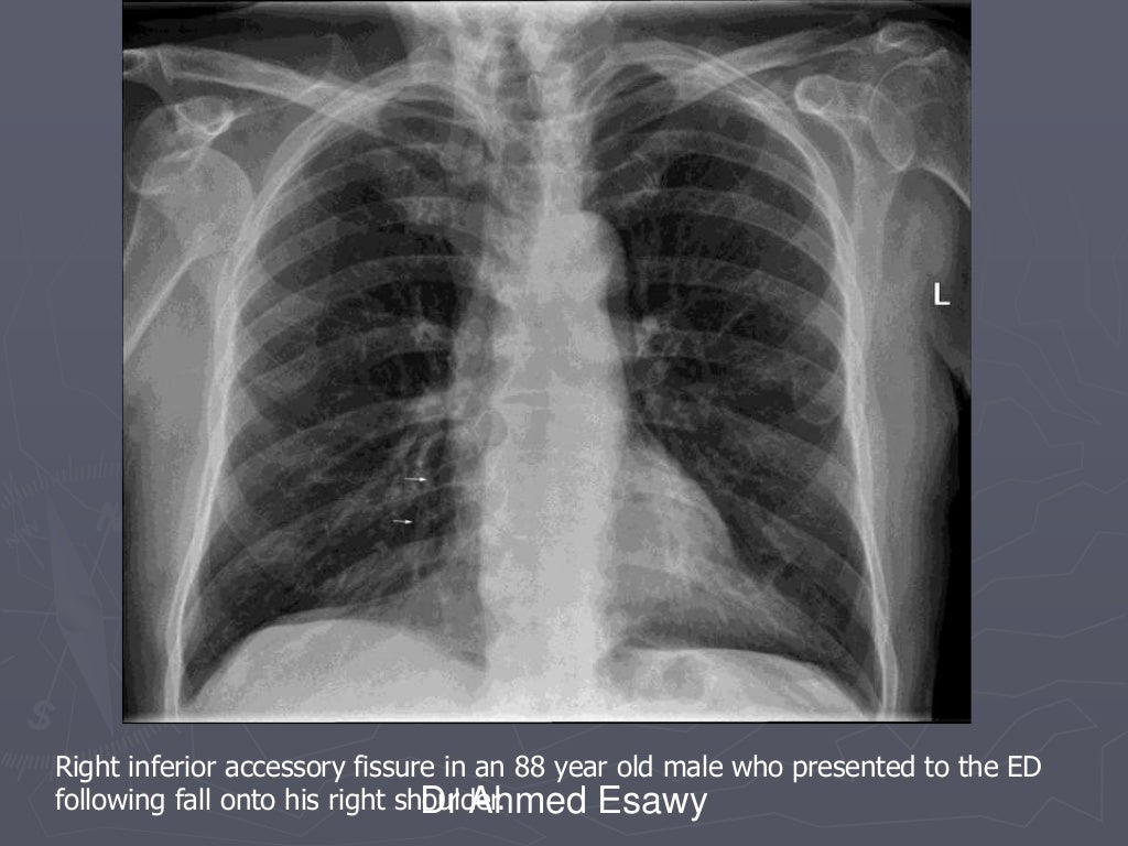 Linear lung density x ray Dr Ahmed Esawy