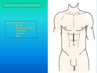 INCISION MEDIA SUPRAUMBILICAL 
Órganos accesados: 
Hígado 
Vesícula y Vía Biliar 
Estomago 
Páncreas 
Bazo 
 