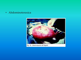 Lineas abdominales | PPT