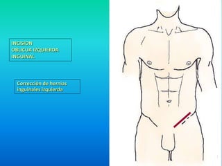 Lineas abdominales