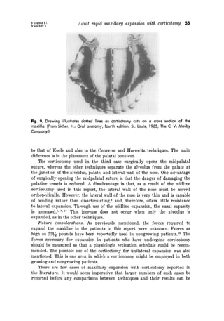 Volunze 67
Number 1
Adult rapid maxillary expansion with corticotomy 55
Fig. 9. Drawing illustrates dotted lines as corticotomy cuts on a cross section of the
maxilla. (From Sicher, H.: Oral anatomy, fourth edition, St. Louis, 1965, The C. V. Mosby
Company.]
to that of Koele and also to the Converse and Horowitz techniques. The main
difference is in the placement of the palatal bone cut.
The corticotomy used in the third case surgically opens the midpalatal
suture, whereas the other techniques separate the alveolus from the palate at
the junction of the alveolus, palate, and lateral wall of the nose. One advantage
of surgically opening the midpalatal suture is that the danger of damaging the
palatine vessels is reduced. A disadvantage is that, as a result of the midline
corticotomy used in this report, the lateral wall of the nose must be moved
orthopedically. However, the lateral wall of the nose is very thin and is capable
of bending rather than disarticulating,4 and, therefore, offers little resistance
to lateral expansion. Through use of the midline expansion, the nasal capacity
is increased6, 7yI7 This increase does not occur when only the alveolus is
expanded, as in the other techniques.
Future considerations. As previously mentioned, the forces required to
expand the maxillae in the patients in this report were unknown. Forces as
high as 2295 pounds have been reportedly used in nongrowing patients.lO The
forces necessary for expansion in patients who have undergone corticotomy
should be measured so that a physiologic Rctivation schedule could be recom-
mended. The possible use of the corticotomy for unilateral expansion was also
mentioned. This is one area in which a corticotomy might be employed in both
growing and nongrowing patients.
There are few cases of maxillary expansion with corticotomy reported in
the literature. It would seem imperative that larger numbers of such cases be
reported before any comparisons between techniques and their results can be
 