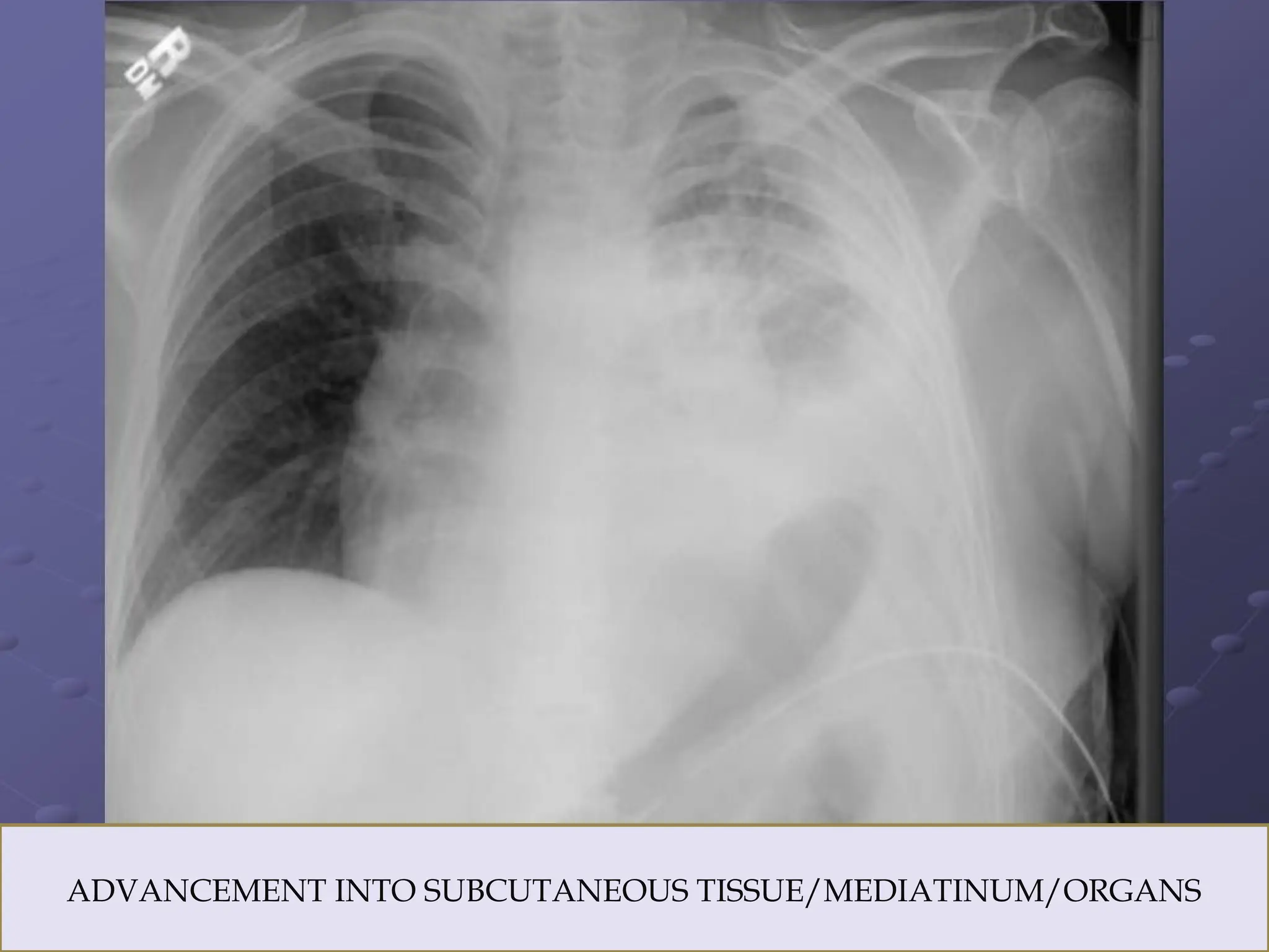 LINES AND TUBES IN HEST RADIOGRAPH .pptx