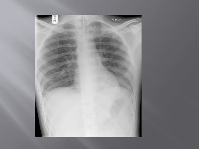 LINES AND TUBES IN HEST RADIOGRAPH .pptx