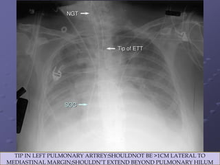 LINES AND TUBES IN CHEST RADIOGRAPH.pptx