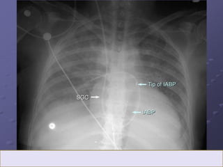 Chest Panel Line LINES AND TUBES IN CHEST RADIOGRAPH.pptx