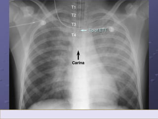 Chest Panel Line LINES AND TUBES IN CHEST RADIOGRAPH.pptx
