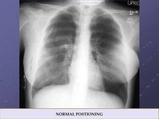 Chest Panel Line LINES AND TUBES IN CHEST RADIOGRAPH.pptx