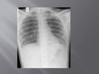 Chest Panel Line LINES AND TUBES IN CHEST RADIOGRAPH.pptx
