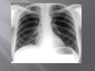 LINES AND TUBES IN CHEST RADIOGRAPH.pptx