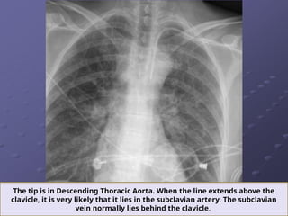 LINES AND TUBES IN CHEST RADIOGRAPH.pptx