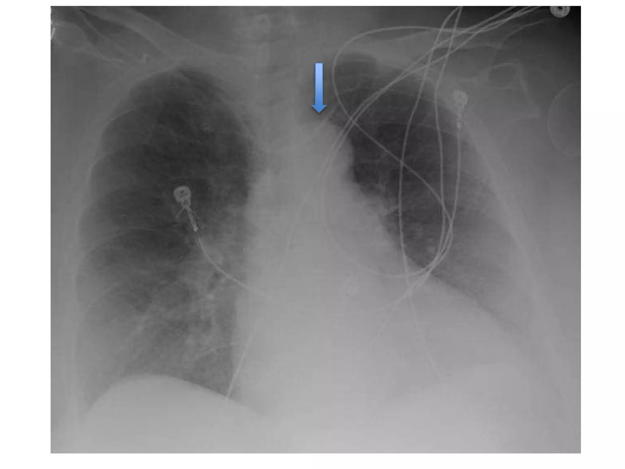Chest Panel Line Lines and tubes in xray | PPTX