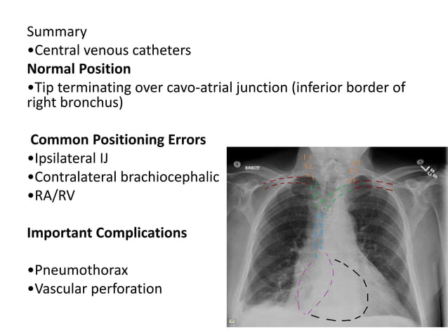 Lines and tubes in xray | PPTX | Heart and Cardiovascular Diseases ...