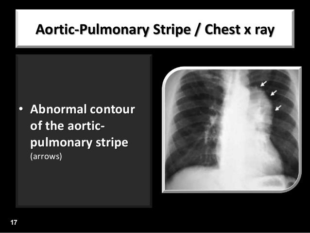 Lines & mediastinal stripes 02