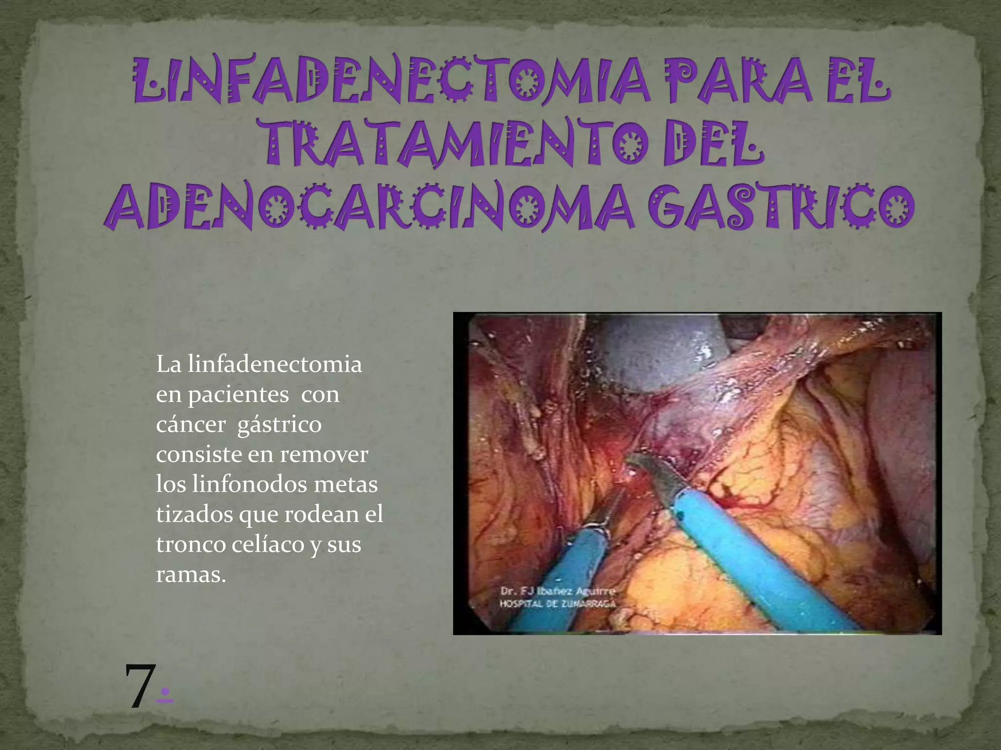 La linfadenectomia
 en pacientes con
 cáncer gástrico
 consiste en remover
 los linfonodos metas
 tizados que rodean el
 tronco celíaco y sus
 ramas.



7.
 
