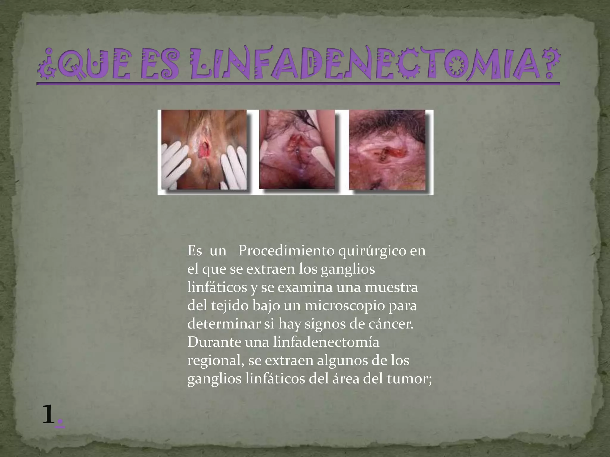 Es un Procedimiento quirúrgico en
     el que se extraen los ganglios
     linfáticos y se examina una muestra
     del tejido bajo un microscopio para
     determinar si hay signos de cáncer.
     Durante una linfadenectomía
     regional, se extraen algunos de los
     ganglios linfáticos del área del tumor;

1.
 