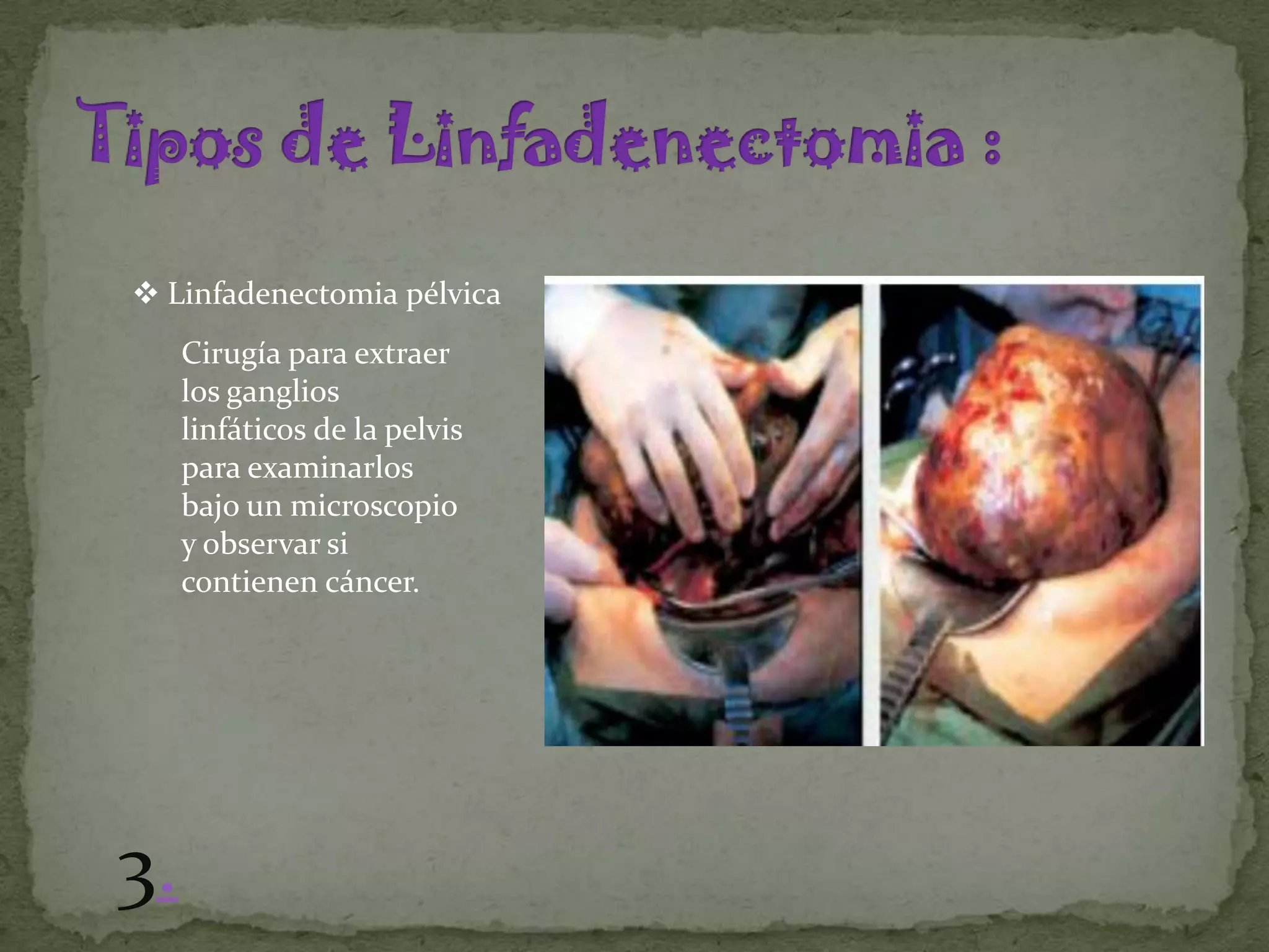  Linfadenectomia pélvica
     Cirugía para extraer
     los ganglios
     linfáticos de la pelvis
     para examinarlos
     bajo un microscopio
     y observar si
     contienen cáncer.




3.
 