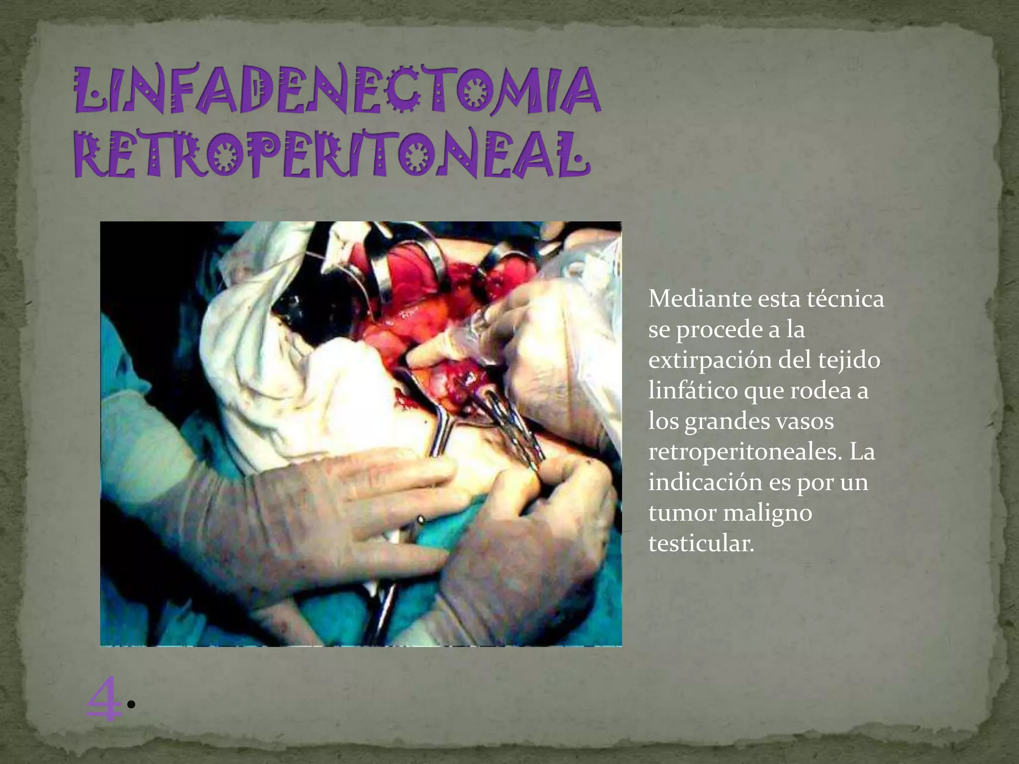 Mediante esta técnica
     se procede a la
     extirpación del tejido
     linfático que rodea a
     los grandes vasos
     retroperitoneales. La
     indicación es por un
     tumor maligno
     testicular.




4.
 