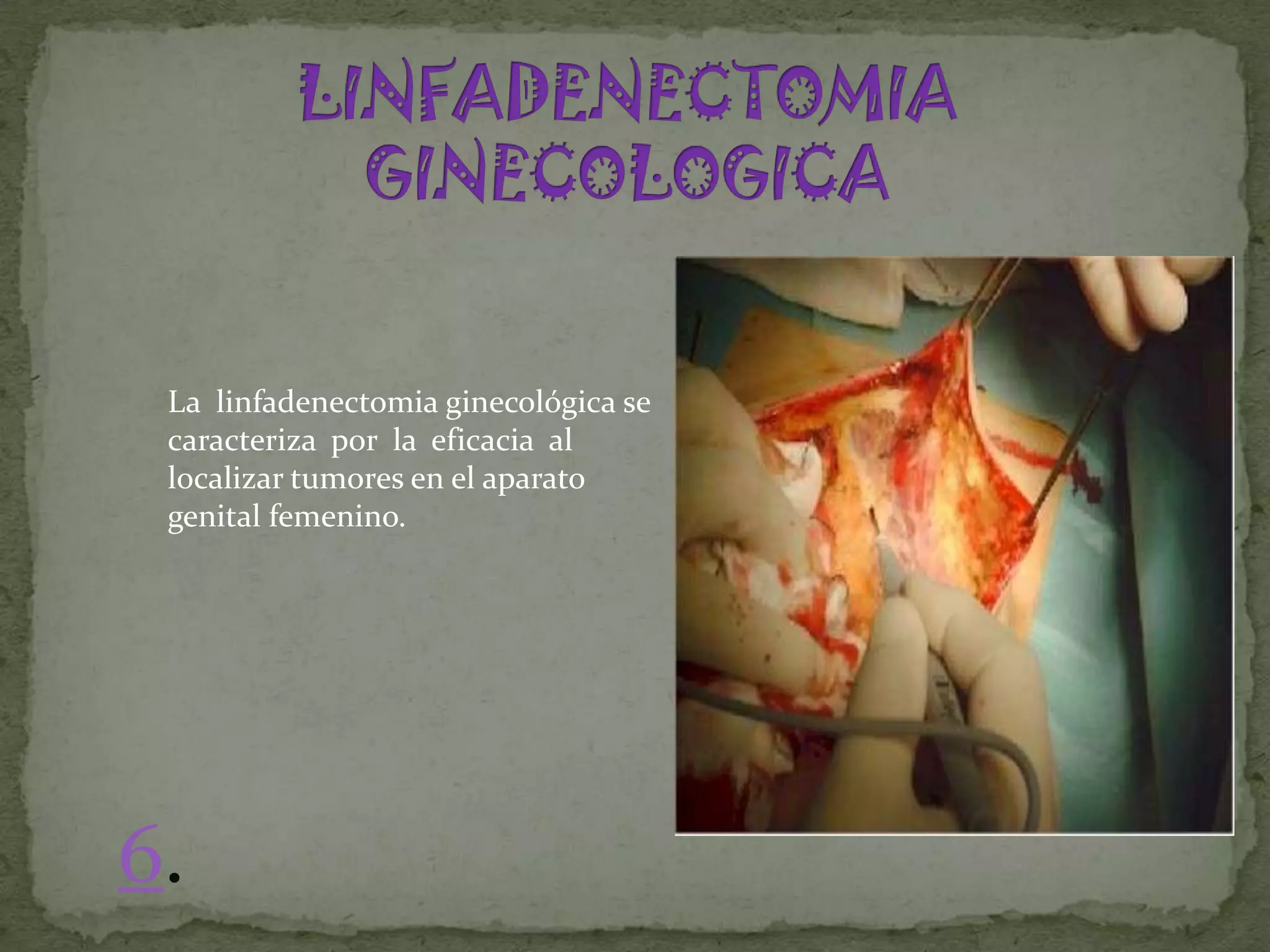 La linfadenectomia ginecológica se
 caracteriza por la eficacia al
 localizar tumores en el aparato
 genital femenino.




6.
 