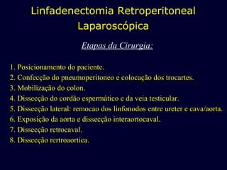 Etapas da Cirurgia: 1. Posicionamento do paciente. 2. Confecção do pneumoperitoneo e colocação dos trocartes. 3. Mobilização do colon. 4. Dissecção   do cordão espermático e da veia testicular. 5. Dissecção lateral: remocao dos linfonodos entre ureter e cava/aorta. 6. Exposição da aorta e dissecção interaortocaval. 7. Dissecção   retrocaval. 8. Dissecção   rertroaortica. Linfadenectomia Retroperitoneal Laparoscópica 