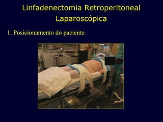 1. Posicionamento do paciente Linfadenectomia Retroperitoneal Laparoscópica 