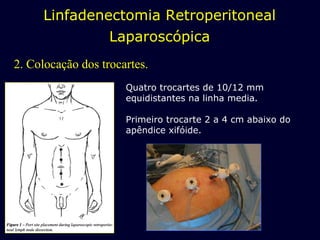 2. Colocação dos trocartes. Quatro trocartes de 10/12 mm equidistantes na linha media. Primeiro trocarte 2 a 4 cm abaixo do apêndice xifóide. Linfadenectomia Retroperitoneal Laparoscópica 