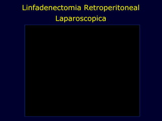 Linfadenectomia Retroperitoneal Laparoscopica 