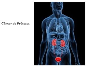 Câncer de Próstata
 