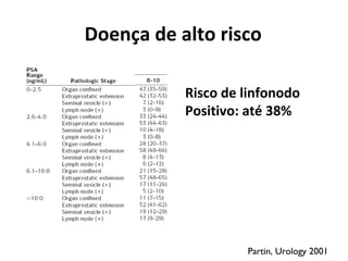 Doença de alto risco
Risco de linfonodo
Positivo: até 38%
Partin, Urology 2001
 