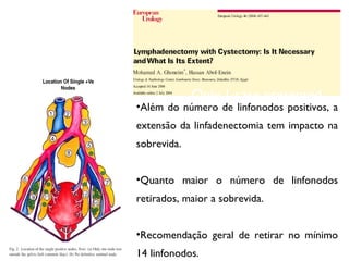 Only 1 case presented
with a single LN
outside the pelvis
•Além do número de linfonodos positivos, a
extensão da linfadenectomia tem impacto na
sobrevida.
•Quanto maior o número de linfonodos
retirados, maior a sobrevida.
•Recomendação geral de retirar no mínimo
14 linfonodos.
 